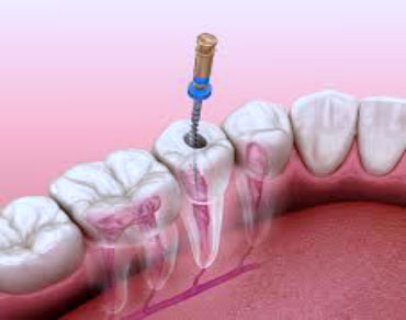 عصب کشی ریشه(درمان ریشه) در شاهین شهر اصفهان
